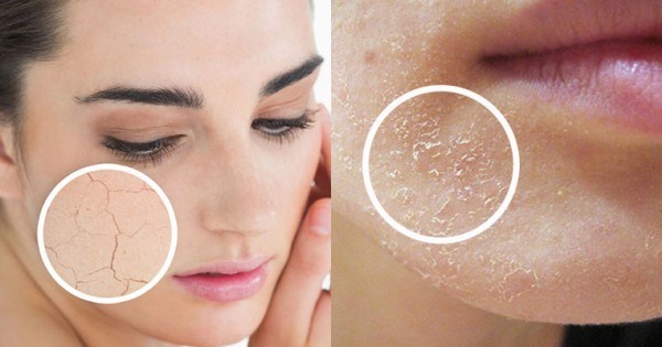 Mỡ Dưỡng ẩm nào phù hợp với làn da bị khô