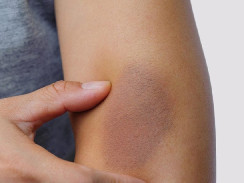 GIẢM TIỂU CẦU - NGUYÊN NHÂN, TRIỆU CHỨNG VÀ CÁCH ĐIỀU TRỊ